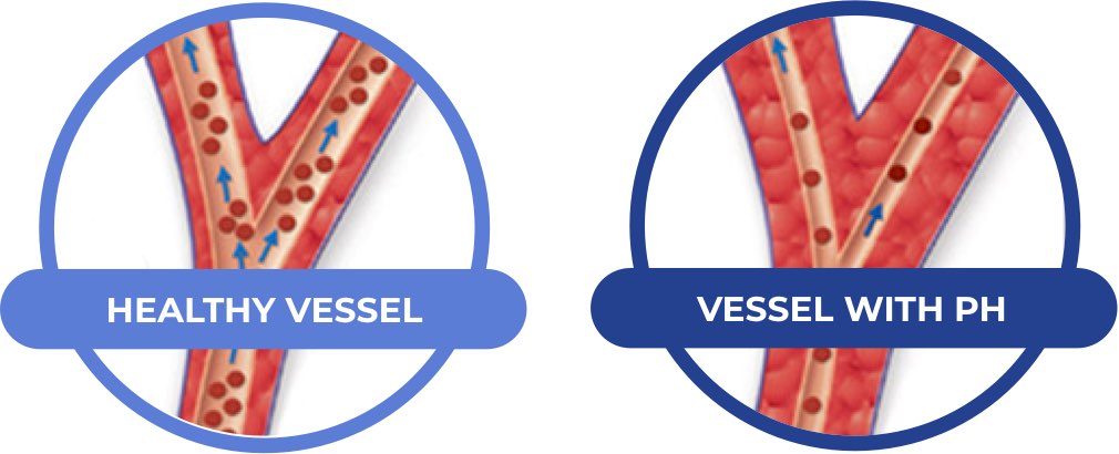 A healthy blood vessel and vessel with PAH