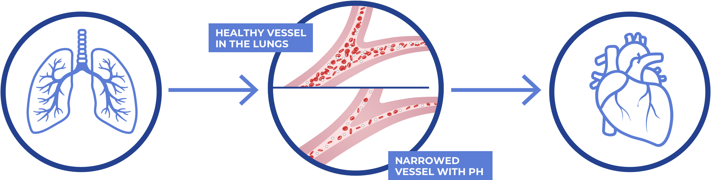 PH-ILD progression can lead to a damaged and weakened heart