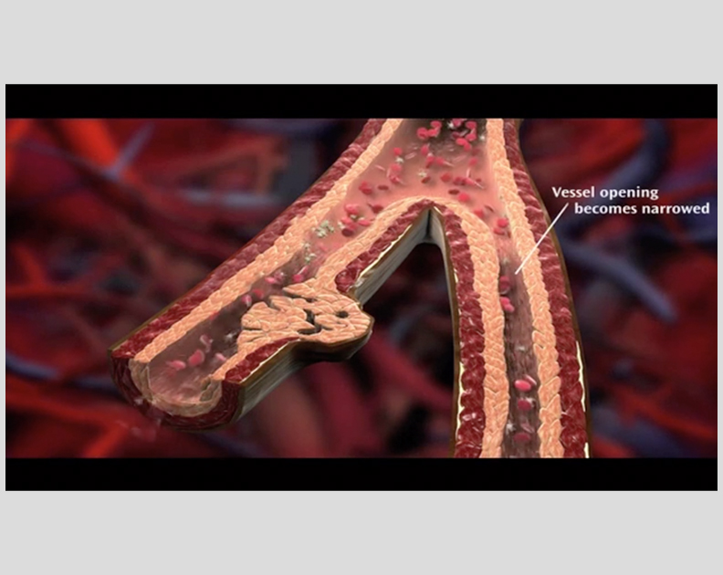 Remodulin Patient Video: How Blood Flows in the Vessels in the Lungs thumbnail